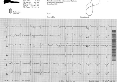 Borderline Ecg And Right Atrial Enlargement But Cardiologist Says Its