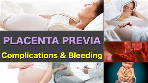 Placenta Previa Complications Placenta Previa Bleeding Delivery Of
