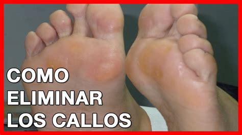 9 Soluciones Para Combatir Y Quitar Los Callos De Los Pies Eliminarlos