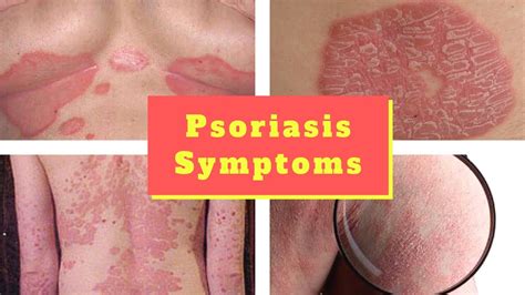 Psoriasis Pictures Hd Signs Symptoms Images Photos And Pictures Of Psoriasis Scalp Body