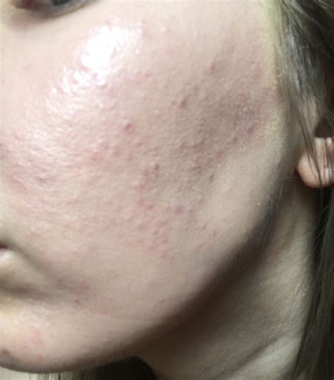 Help 30 Year Old Female With Sudden Acne All Over Cheeks Adult Acne