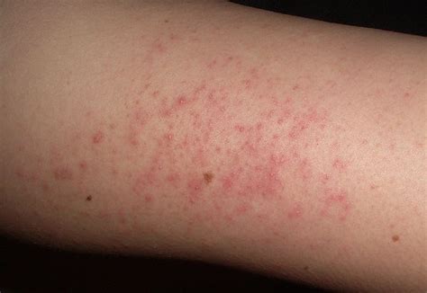Pimples On Arms Dorothee Padraig South West Skin Health Care