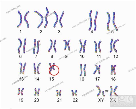 Karyotype Of Prader Willi Syndrome Labelled 3d Illustration Stock