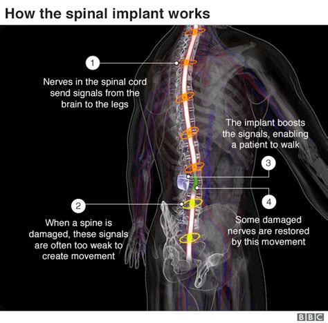 Spinal Implant Helps Three Paralysed Men Walk Again Bbc News