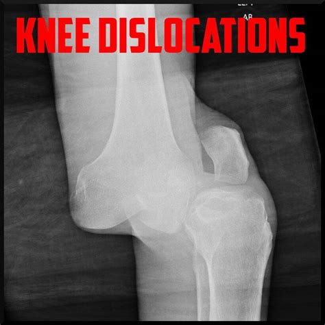 A Quick Update On Knee Dislocations Sports Medicine Review