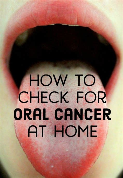 What Does Stage 1 Throat Cancer Look Like Pin On Fitness Ideas It
