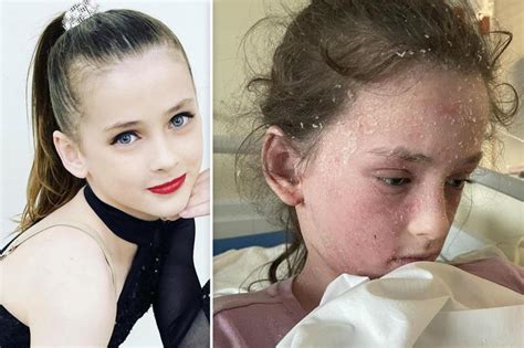 Pre Teen Dancer Allergic To Tears And Sweat Due To Eczema Patabook News