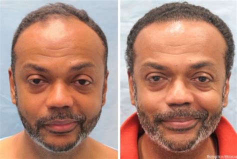 Likely, a cure for male hair loss would also crossover and be a female hair loss cure as well. New breakthrough solution reverses hair loss, re-grows it ...