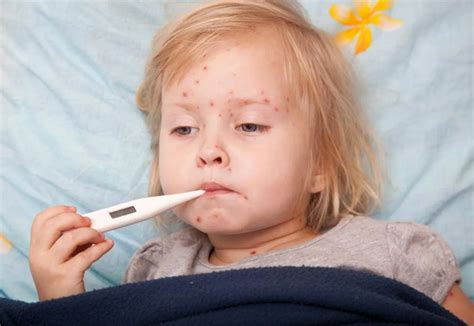 Chicken Pox How To Treat Symptoms Hydropeptide Official Site