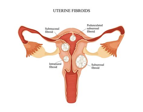 Norton Gynecologist Explains Fibroids And Endometriosis
