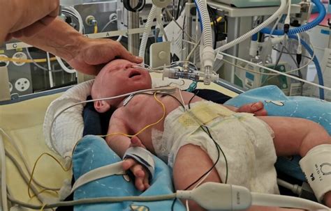 Neonatal Lung Simulator Lusi From Neosim Creates Realistic Pediatric