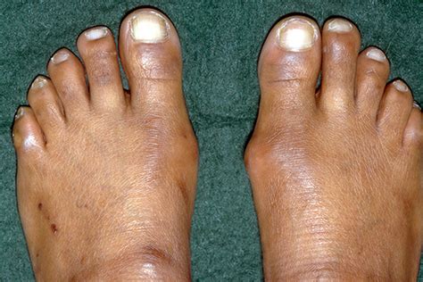 Bunions Causes Symptoms And Diagnosis Bunion Corrector And Bunion Toe Separator Orthopedic