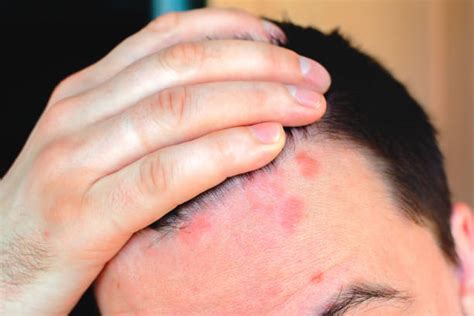 440 Scalp Dermatitis Stock Photos Pictures And Royalty Free Images Istock
