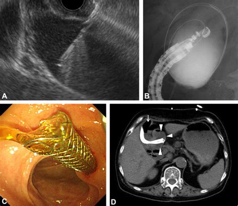 Eus Guided Gallbladder Drainage For Rescue Treatment Of Malignant