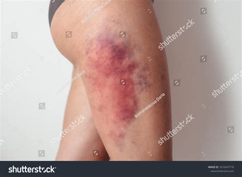 Hemorrhage Leg