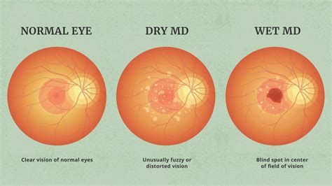 Macular Degeneration Amd Articles On Wet And Dry