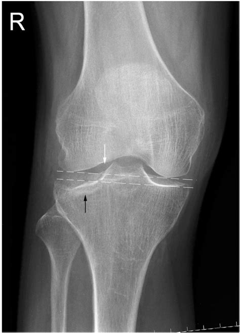Tibial Plateau Fractures Trauma Orthobullets