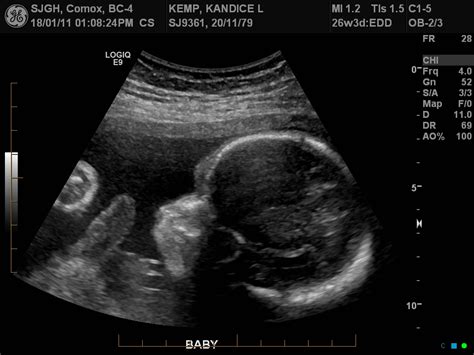 Baby Eschbaumer Baby Ultrasound 26 Weeks 3 Days