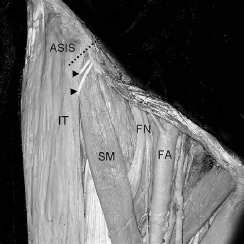 Pdf Anatomy Of The Lateral Femoral Cutaneous Nerve Relevant To