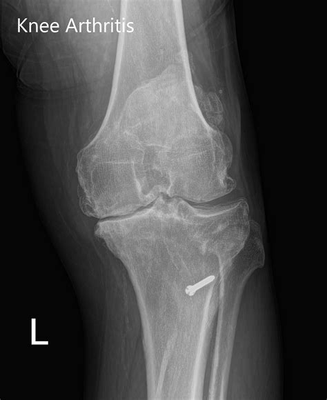 Case Study Custom Left Knee Replacement In 59 Yr Old Female