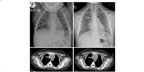 Follow Up Chest X Ray And Chest Ct Scan After 4 Years Of Catheter