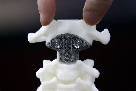 German Patient First To Receive 3d Printed Titanium Spinal Fusion