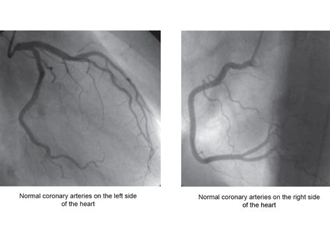 Coronary Angiography Heart Test Recovery And Risk Heart Foundation
