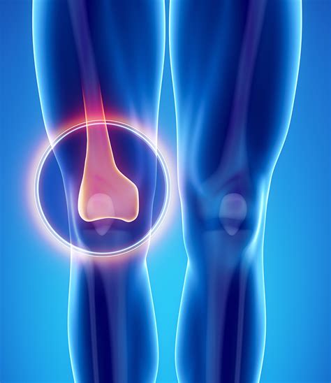 Knee X Ray Cartilage Orthopaedic Specialists Of Central Arizona