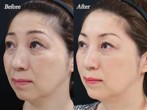 ボトックスによる顔の造形変化 東京 渋谷 美容皮膚科 マグノリア皮膚科クリニック