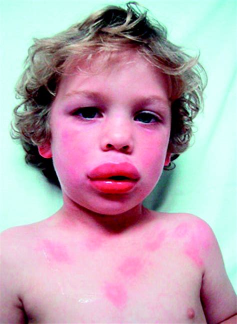 Are The Dangers Of Childhood Food Allergy Exaggerated The Bmj