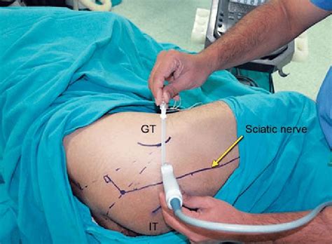 Modified Subgluteal Approach To The Sciatic Nerve Anesthesia Analgesia