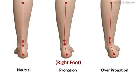 Foot Pronation Underpronation And Overpronation Explained The Foot Clinic