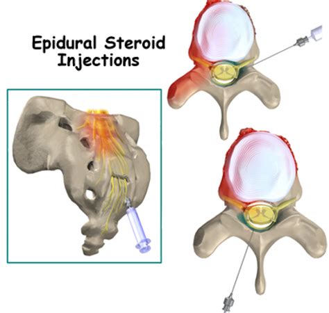 Accurate Education Epidural Injections