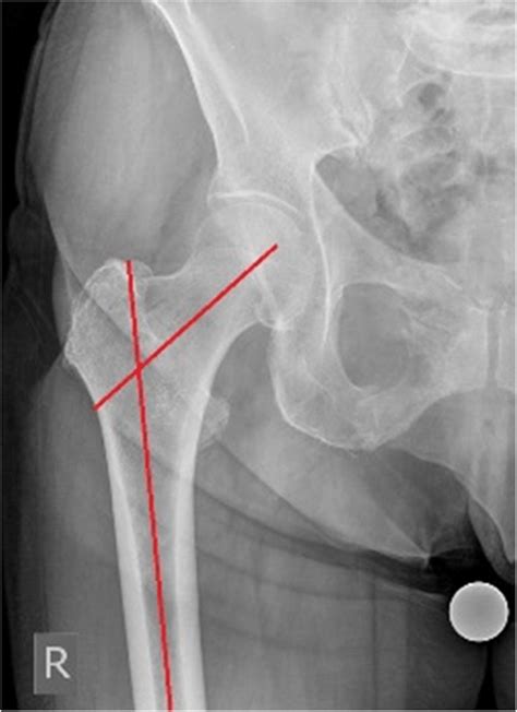 Femoral Neck Shaft Angle Is Angle Formed By The Intersection Of The