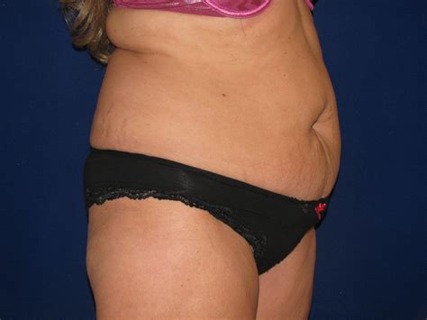 Maybe you would like to learn more about one of these? Abdominoplasty Before and After | LV Plastic Surgery