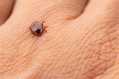Tick Filled With Blood On Human Skin Stock Image Image Of Infestation