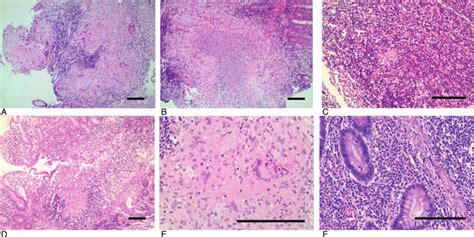 Histopathological Features Of Intestinal Tuberculosis Itb And Crohns