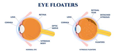 Eye Floaters South Carolina Retina Institute Llc