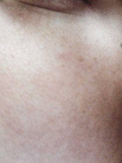 Light Brown Spots On Skin Pictures Photos