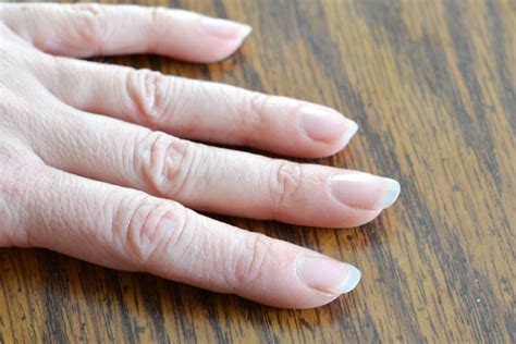 How To Take Care Of Painful Dry Cuticles