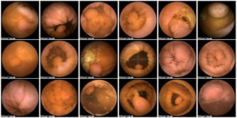 J. Imaging | Free Full-Text | Polyp Detection and Segmentation from 