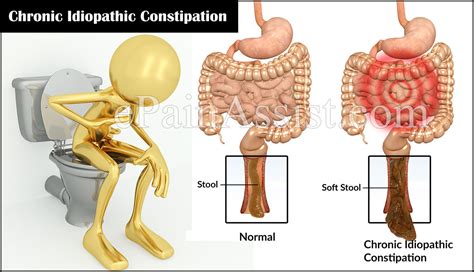 Pain & pain management · 9 years ago. What is Chronic Idiopathic Constipation and How is it Treated?