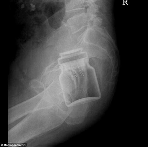 Doctors Share X Rays Of The Strangest Things Theyve Found