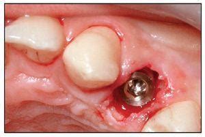 The voiced alveolar nasal is a type of consonantal sound used in numerous spoken languages. Extracción dental atraumática y colocación inmediata de ...