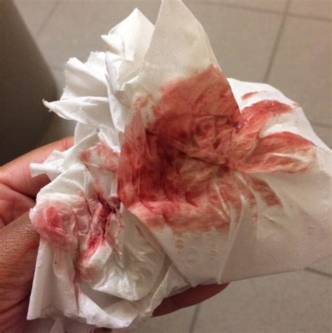This bleeding is caused by a fertilized egg implanting itself you may experience breakthrough bleeding during you pregnancy. Is it normal to spot at 6 weeks pregnant ...