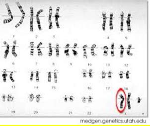 Genetic Cause Klinefelter Syndrome
