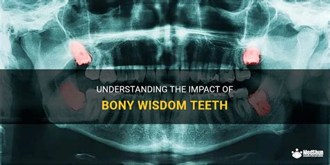 Understanding The Impact Of Bony Wisdom Teeth Medshun
