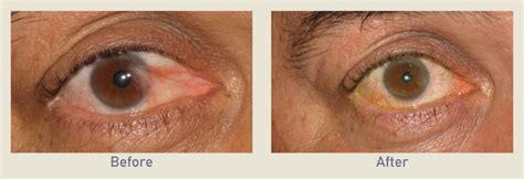 Pterygium Removal Before After Photo Gallery Los Angeles