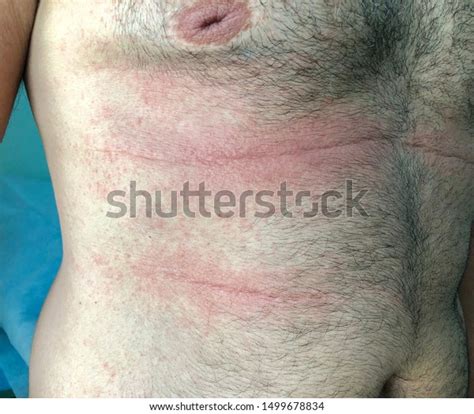 Illdefine Erythematous Itchy Rash Multiple Tiny Stock Photo 1499678834