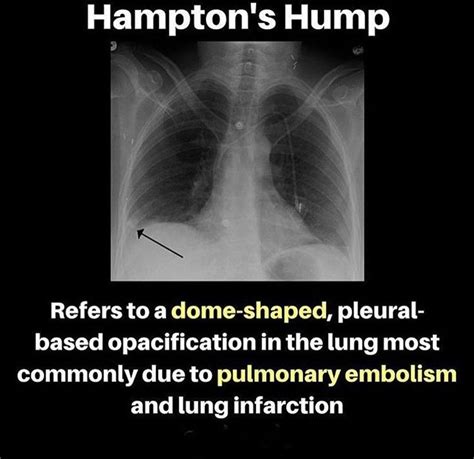 Hamptons Hump Medical The Hamptons Pulmonary Embolism